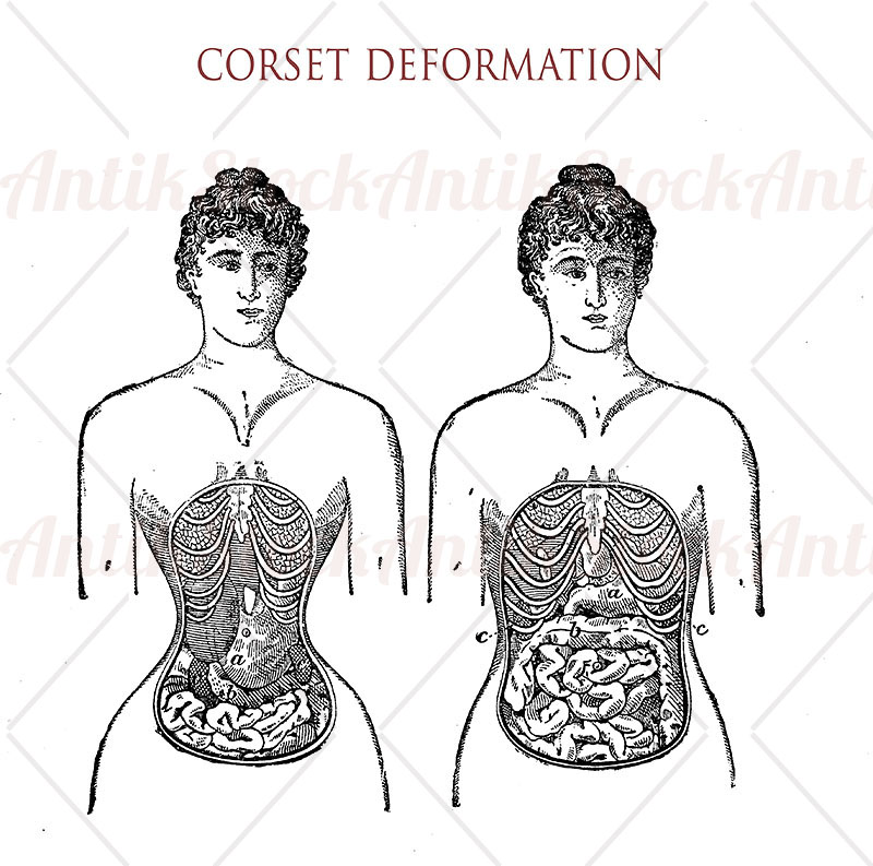 corset-usage-deformation-antikstock