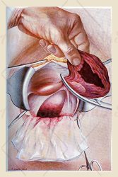 fallopian tube pregnancy surgery