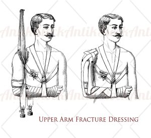 upper arm fracture dressing