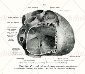 The right atrium of a greatly dilated adult heart